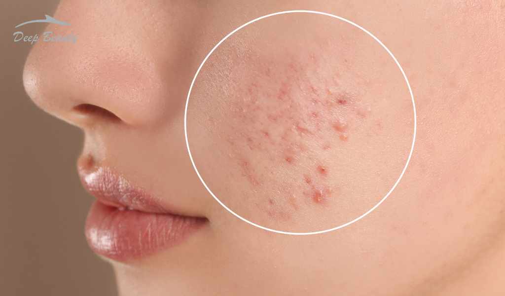 Kandungan Skincare untuk Wajah Bruntusan